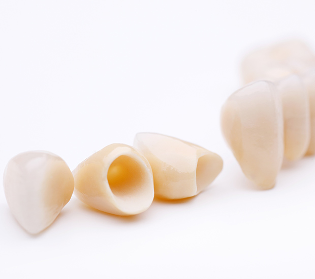 Oakland Dental Crowns and Dental Bridges