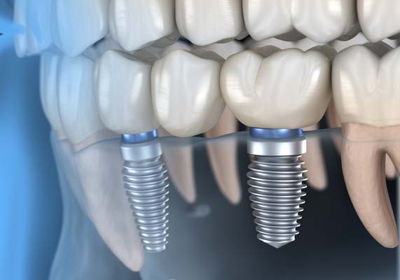 Dental Implant Oakland, CA