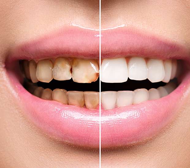 Oakland Dental Implant Restoration