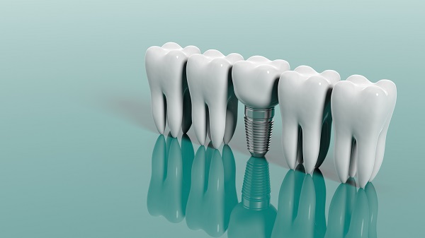 Who Is A Candidate For Dental Implants?