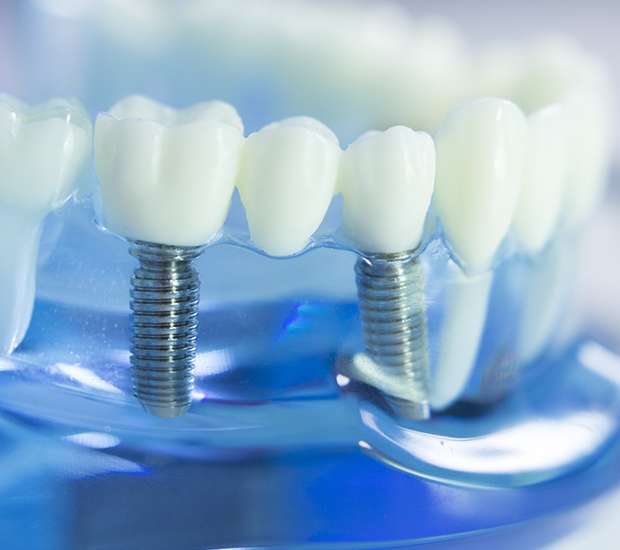 Oakland Dental Implants