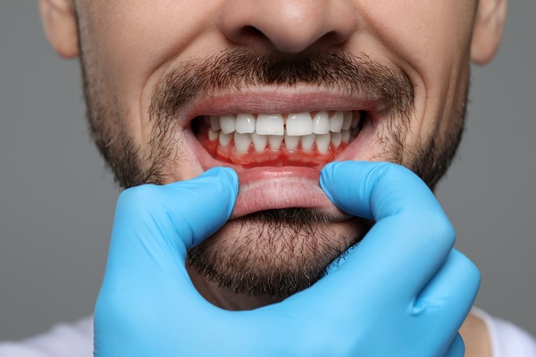 When It Is Time To Seek Professional Gum Disease Treatment
