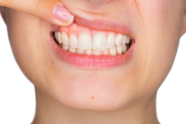 When Is Pinhole Gum Surgery Recommended?